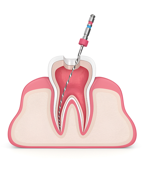 Symptoms of Root Canal Problems