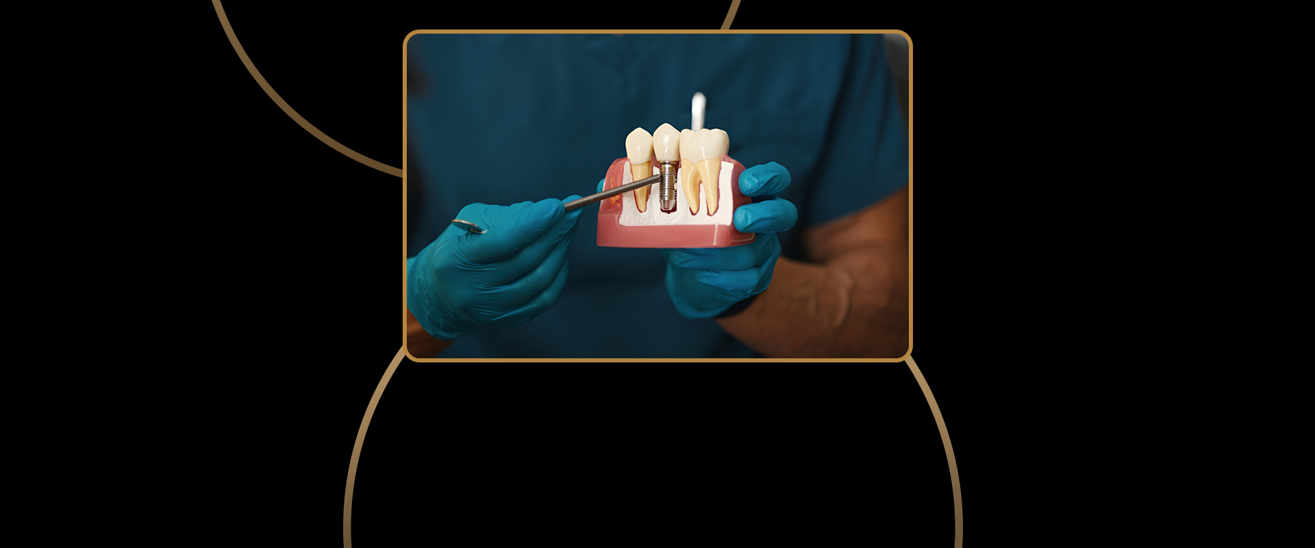 Dental Implants