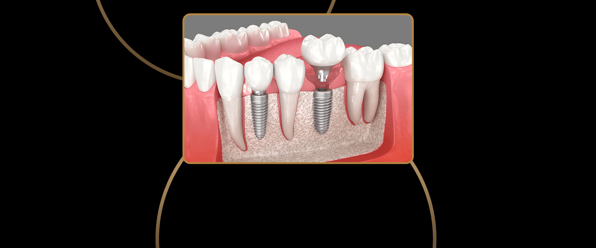 Multiple Tooth Dental Implants