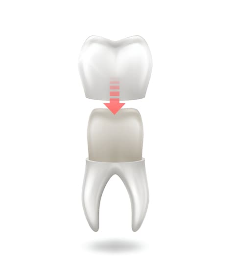 What Are Dental Crowns?