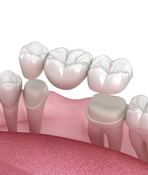What Are Dental Bridges?