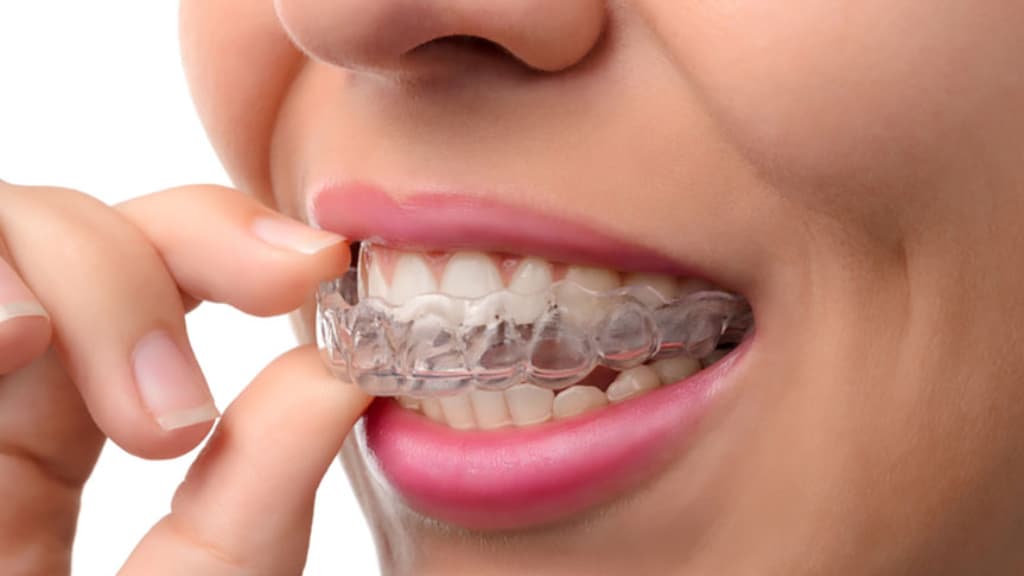 Essential Facts regarding Invisalign dentist and retainers