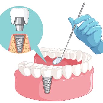 Dental Implant Process