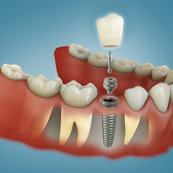 Single Tooth Dental Implants