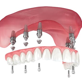 All-on-4 Dental Implants