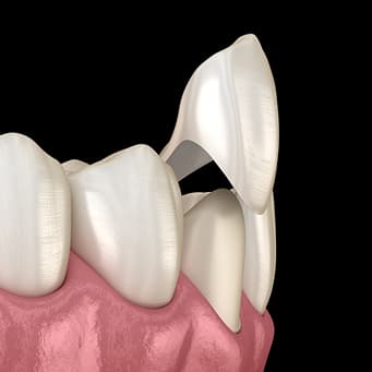 Porcelain Veneers