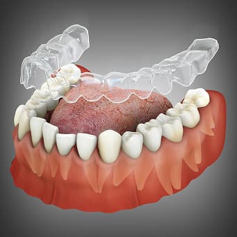 Invisalign Technology