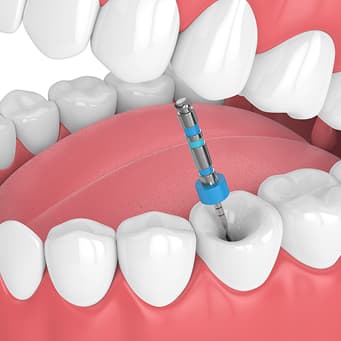 Root Canal