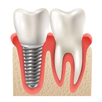 Dental Implants