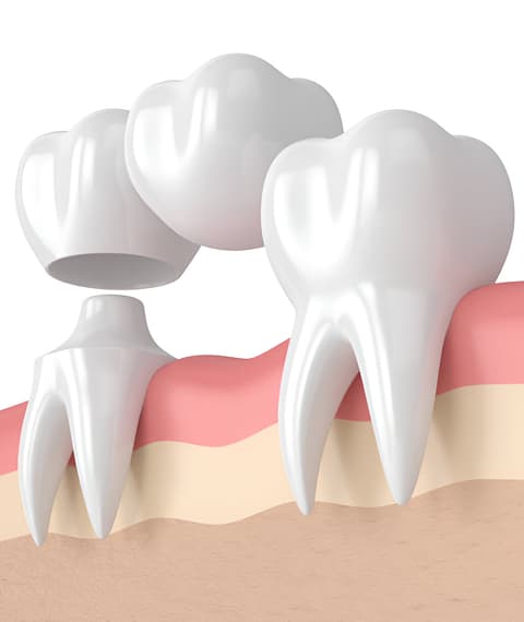 Benefits of Dental Crowns
