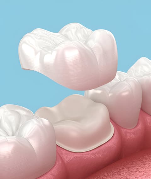 Who Can Benefit from Dental Crowns?