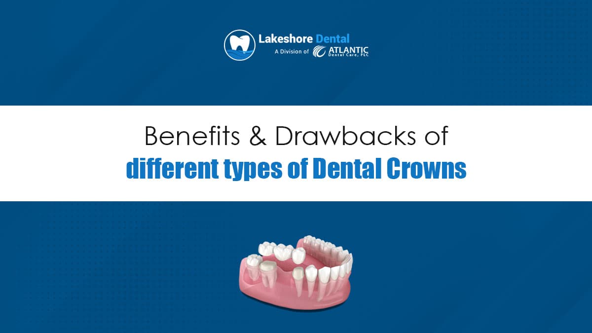 The benefits and drawbacks of different types of dental crowns