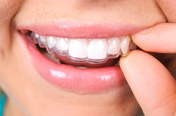 6 Things One should Know about Invisalign