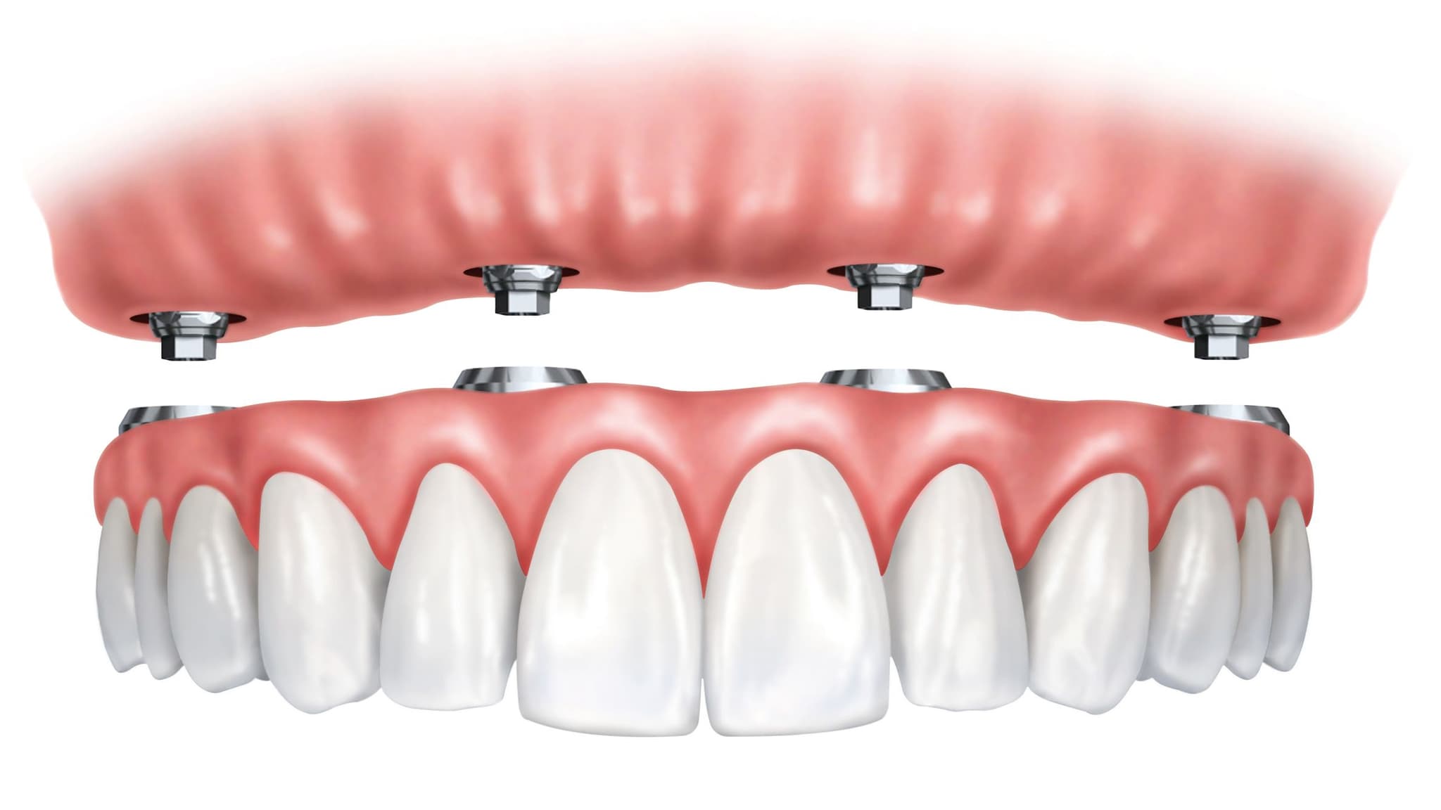 All-on-4 Dental Implants Benefits