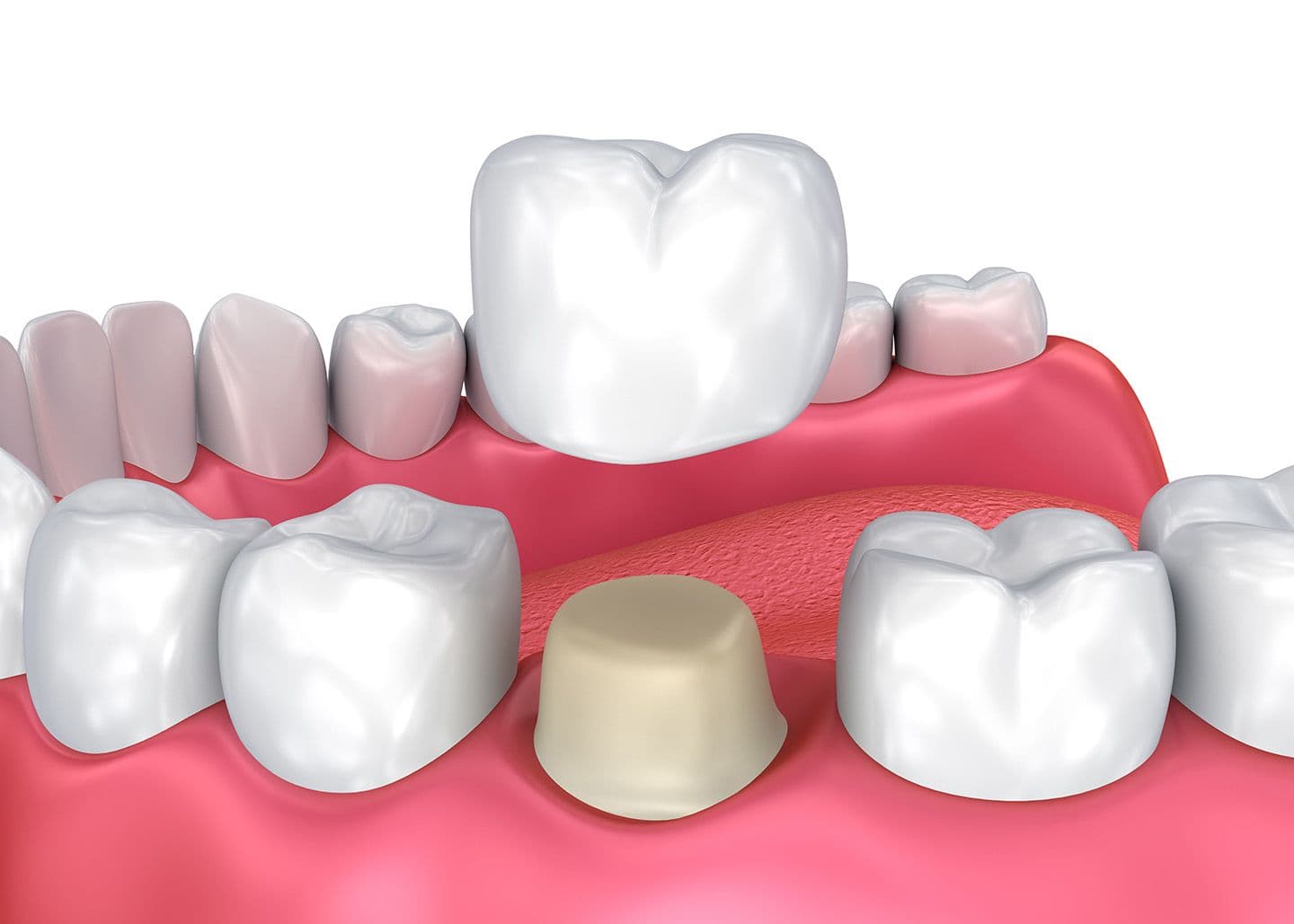 Dental Crowns, Needs, and Its Cost