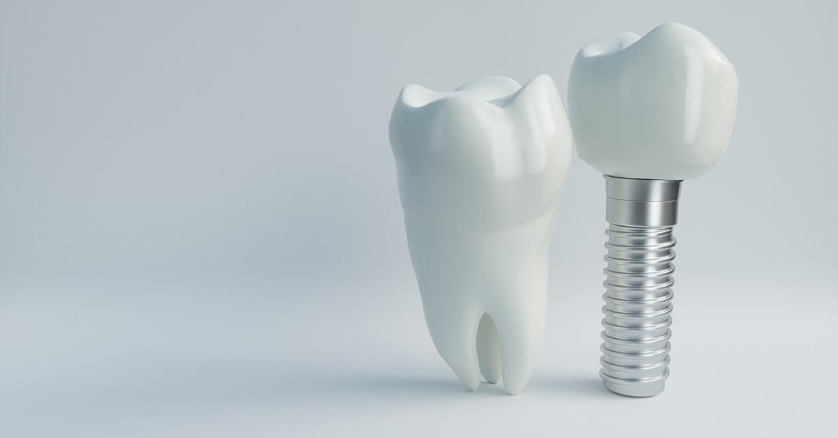 What is the process an individual has to go through to get a single tooth dental implant?