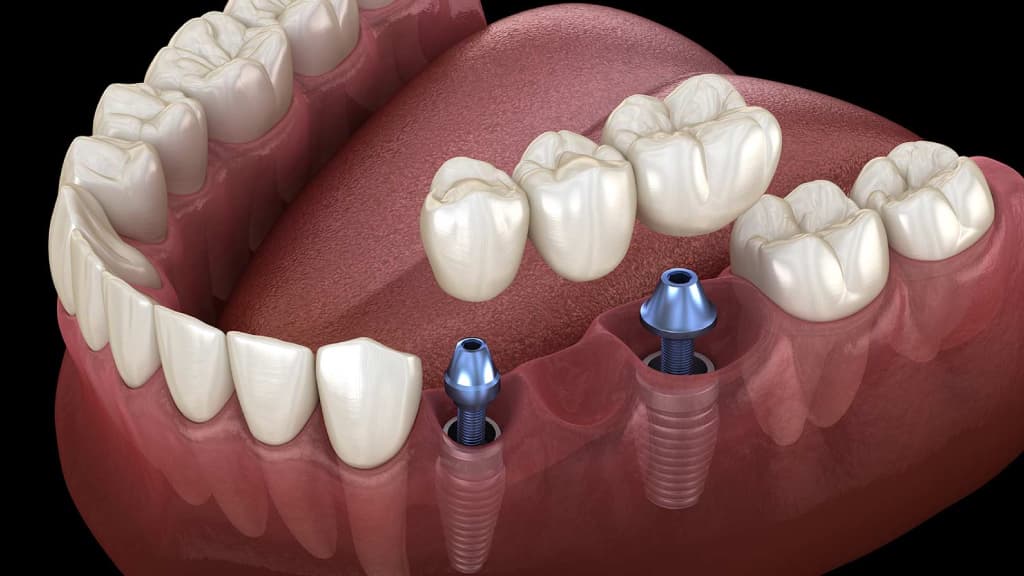 Single tooth dental implants: Replace your missing tooth today!