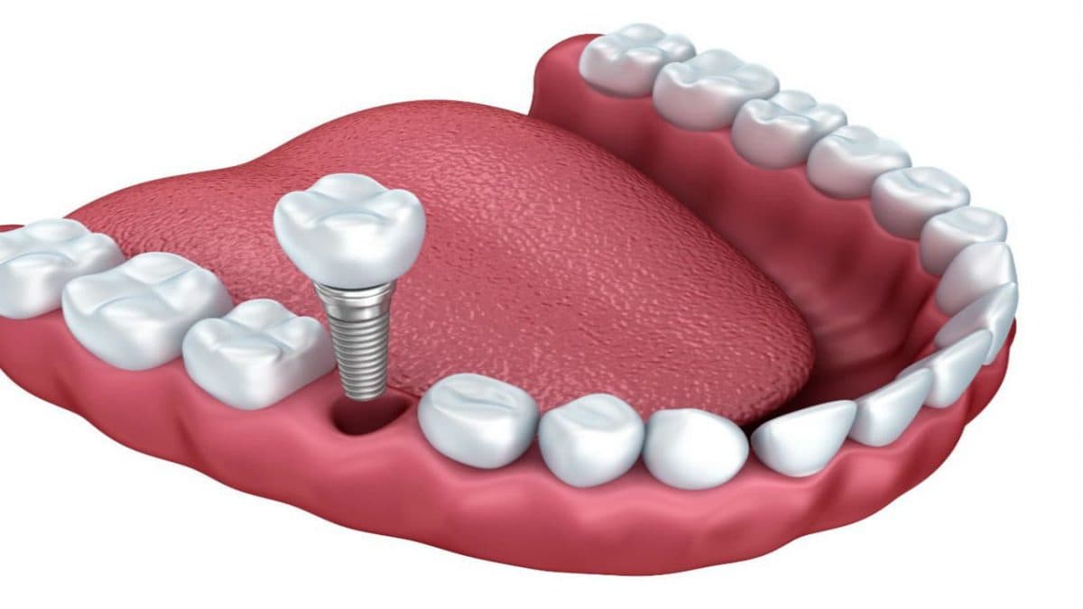 Why Implant Surgery Is Nothing To Be Scared Of