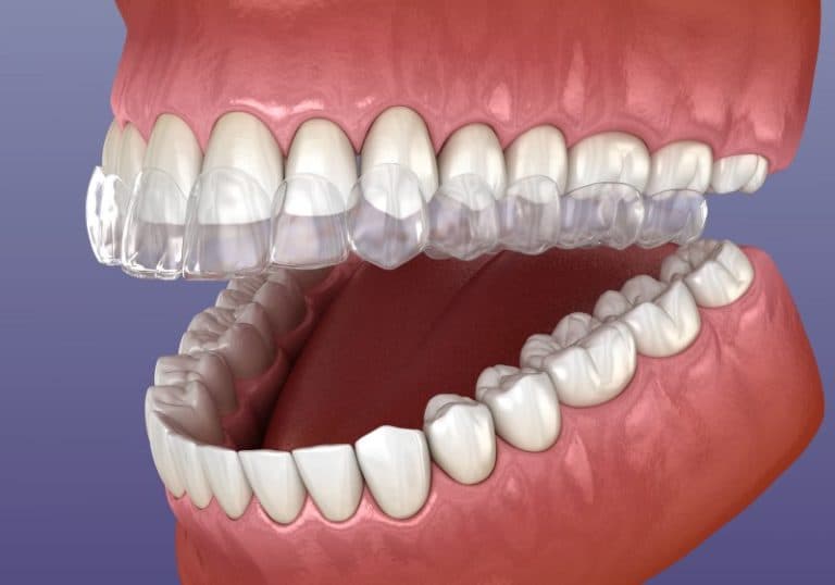 How Long Will You Need to Wear Invisalign?