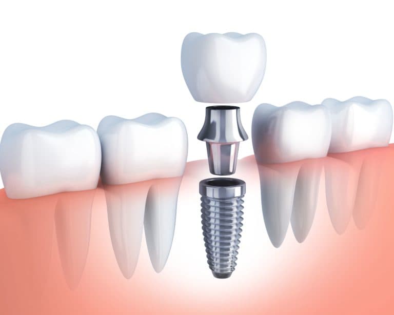 7 Things That Can Happen When You Don’t Replace Missing Teeth with Dental Implants in Virginia Beach