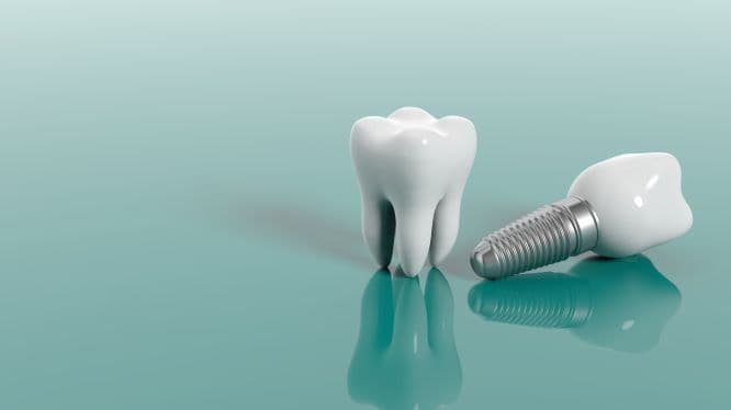 How Long Does It Take to Get Dental Implants?