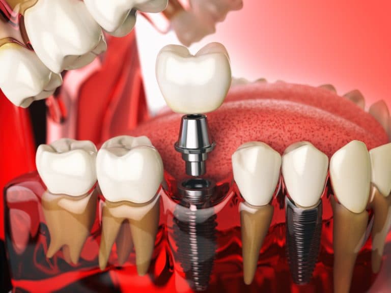 Are Dental Implants Painful?