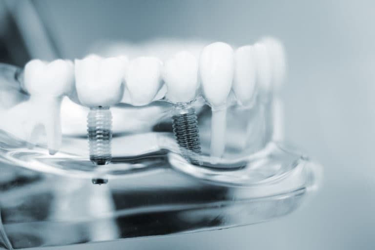 How Long Do Dental Implants Last?