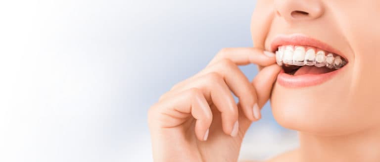 Is Invisalign in Virginia Beach Right for You?