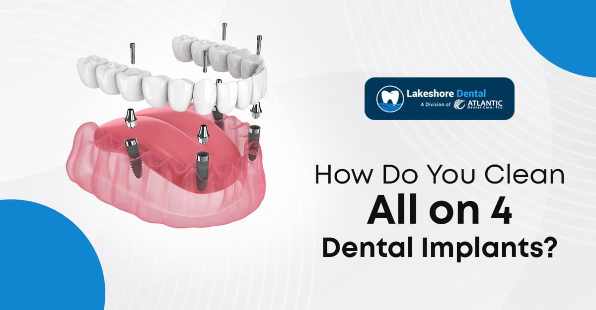 How Do You Clean All on 4 Dental Implants?